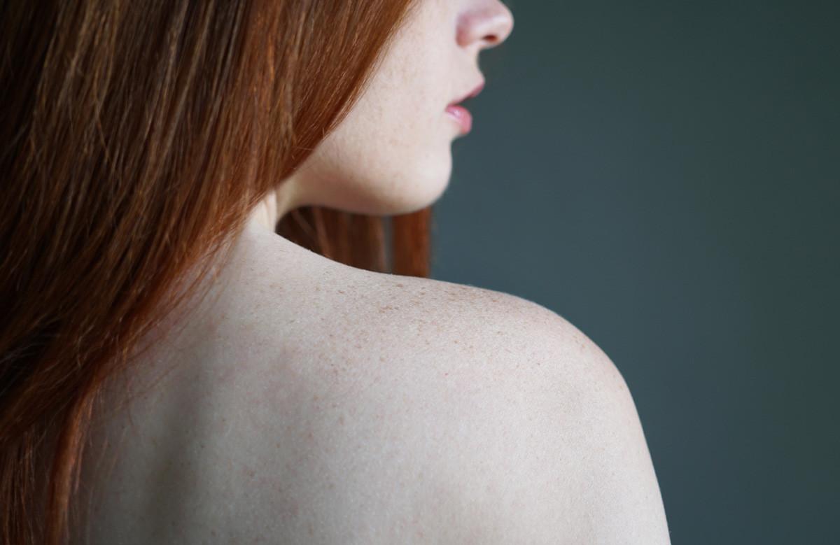 Young Woman Showing Bare Shoulder with Freckles on Skin